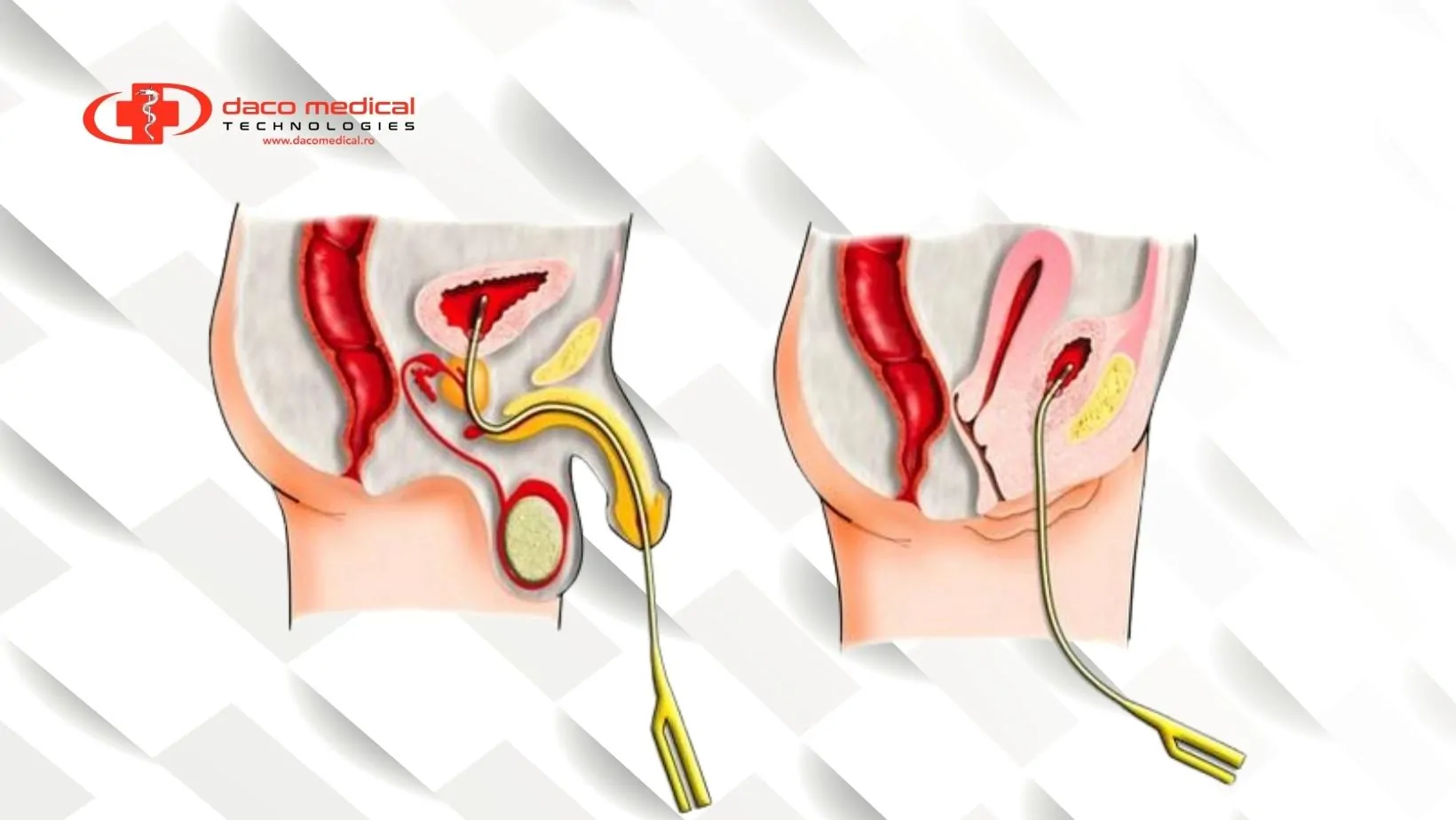 Cateterele în Urologie: Tipuri și prevenție în utilizare