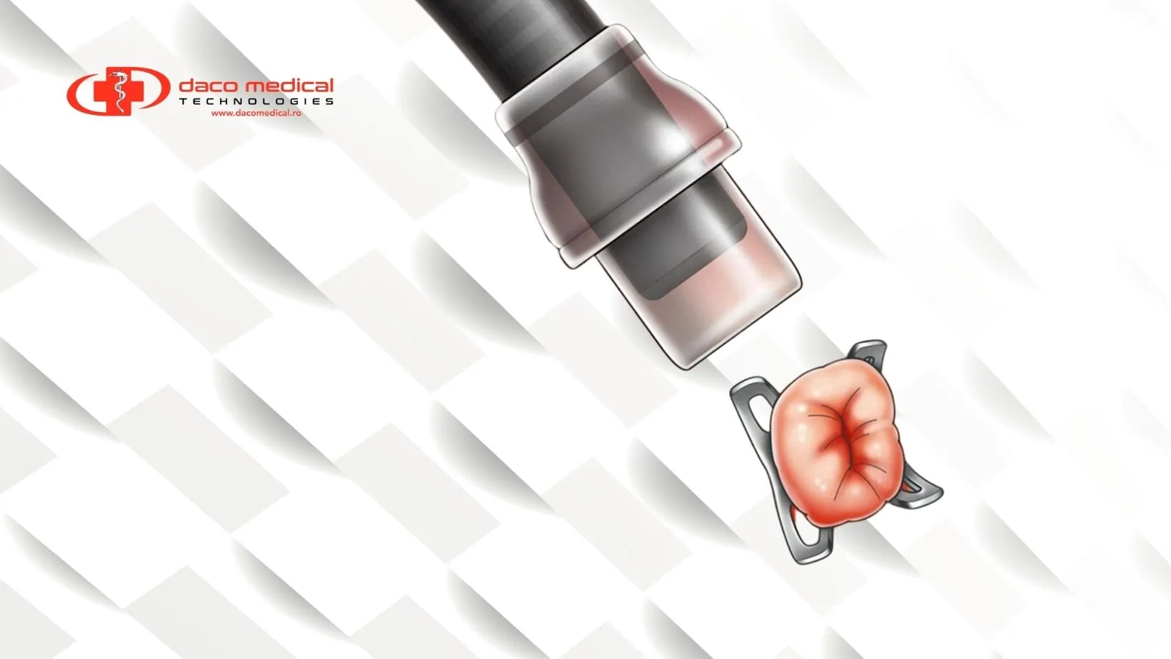 Hemoclips preîncărcați Ovesco®: Siguranță și eficiență în prevenția hemoragiilor gastrointestinale
