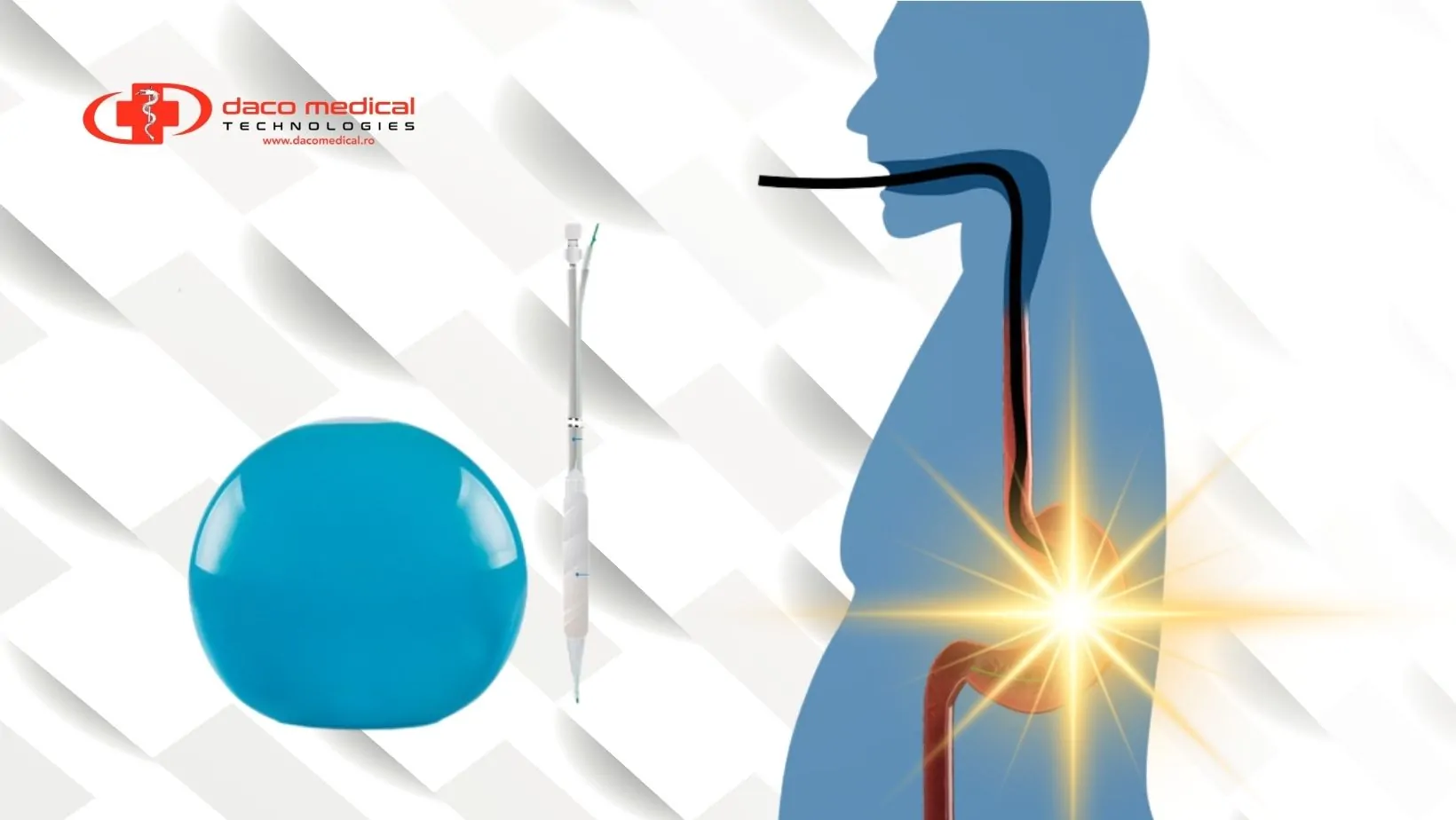 Balonul Gastric Stella – Noua Stea Sigură și Eficientă în Managementul Obezității