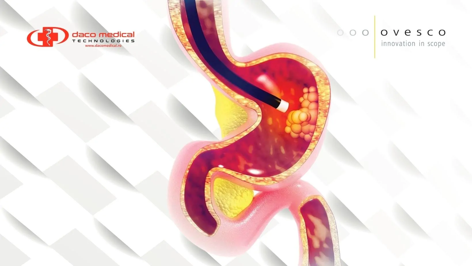 Ovesco® și hemostaza endoscopică: de la controlul hemoragiilor la prevenția complicațiilor