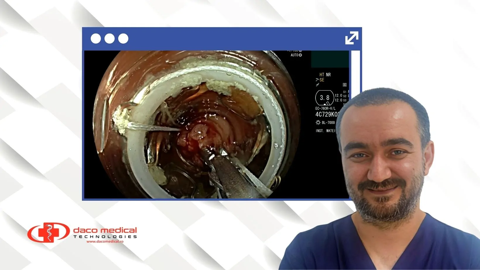 Prima Apendicectomie Endoscopică din România: Cum Inovația Deschide Noi Orizonturi în Medicină