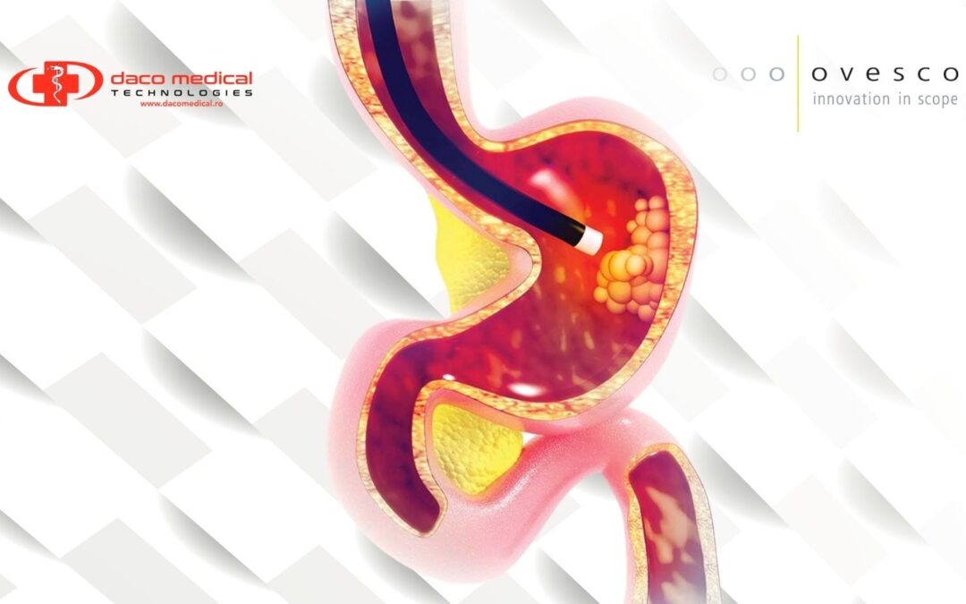 Ovesco® și hemostaza endoscopică: de la controlul hemoragiilor la prevenția complicațiilor